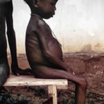 This late 1960s photograph shows a seated, listless child, who was among many kwashiorkor cases found in Nigerian relief camps during the Nigerian–Biafran war. Kwashiorkor is a disease brought on due to a severe dietary protein deficiency, and this child, whose diet fit such a deficiency profile, presented with symptoms including edema of legs and feet, light-colored, thinning hair, anemia, a pot-belly, and shiny skin. A large number of relief camps were established for nutrition assessment and feeding operations for the local villagers around the war zone. Source: Photo: Centers for Disease Control and Prevention, Atlanta, Georgia, USA Public Health Image Library (PHIL). 