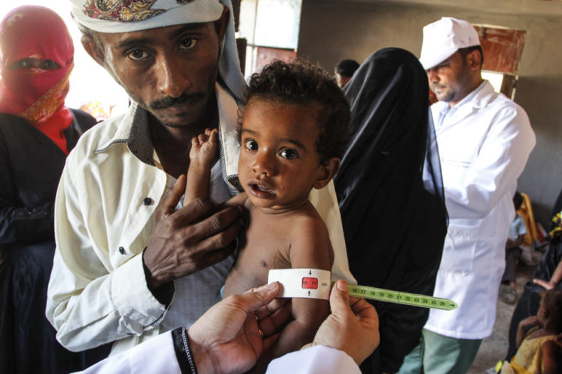Malnutrition in Jemen - Humanity House